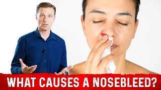 What Causes Nosebleeds/Epistaxis – 8 Common Caus