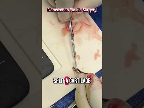 Carving Profile® for lateral crural strut graft with Dr. Kailash Narasimhan