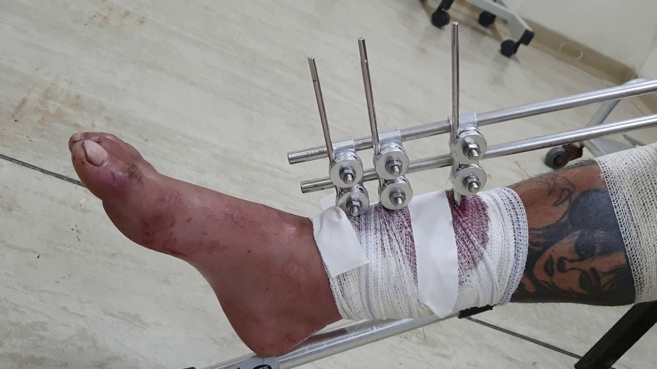 Orientação de fisioterapia para paciente com fixador externo uniplanar