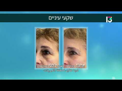 שקעי עיניים