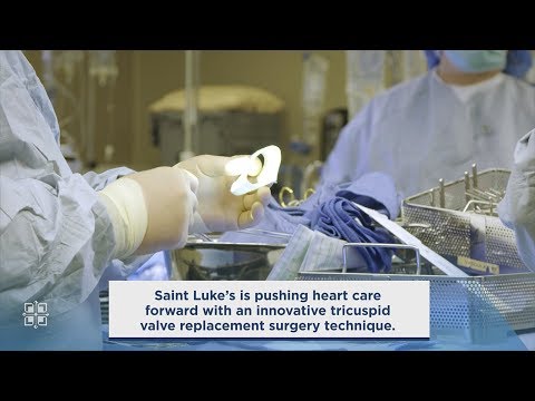 Saint Luke’s Innovative Tricuspid Valve Replacement Surgery Technique