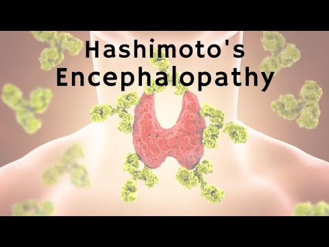 Thyroid Disease as a Cause of Psychosis: Hashimoto's Encephalopathy