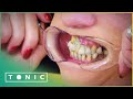 Woman Glues Her Teeth Back In Place To Avoid The Dentist | The Truth About Your Teeth | Tonic