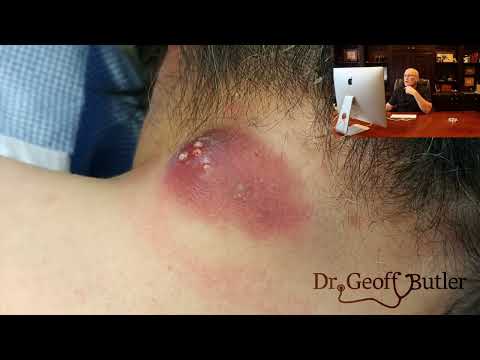 Dr. Butler Reacts (Full Video) | Drainage of Infected Epidermal Cyst
