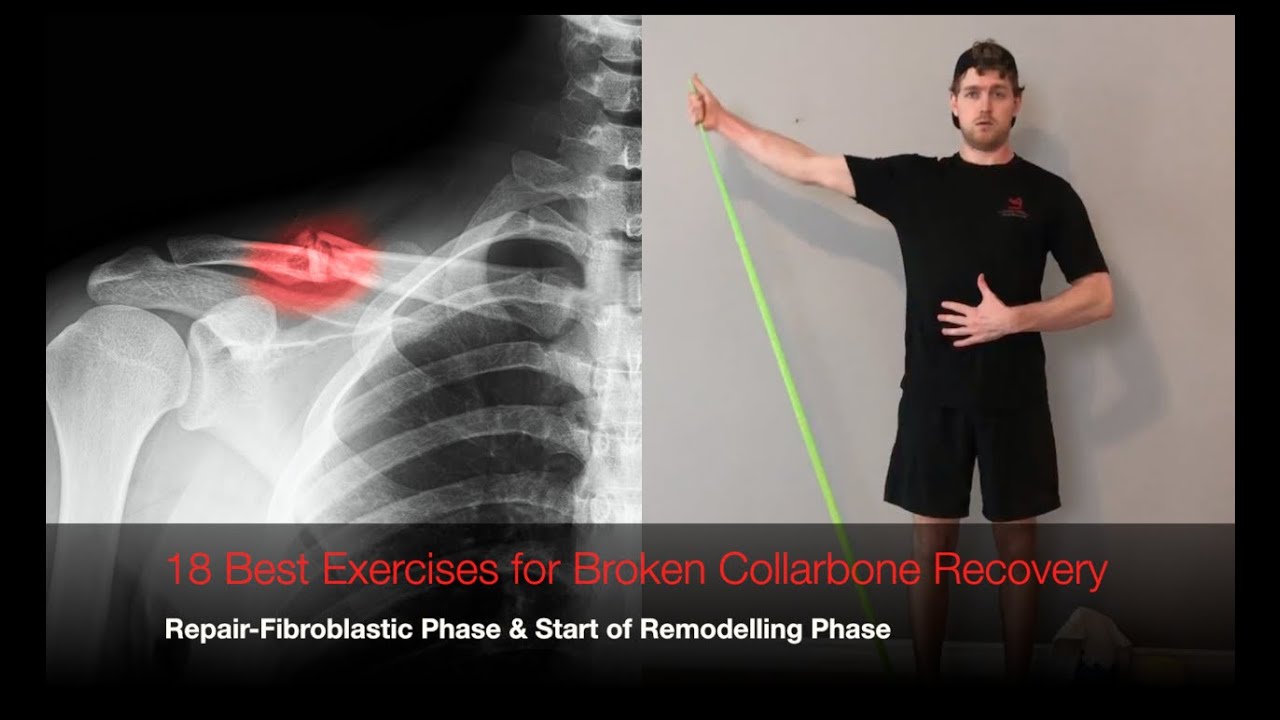 18 Best Exercises for Broken Collarbone Recovery