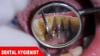 Extreme Dental Cleaning 2 - Black teeth turned white !!