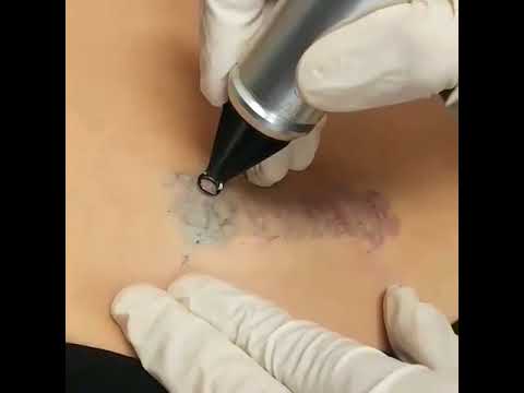 Laser Tattoo Removal Skin Essence by DrPraveen Coimbatore
