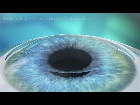 Femto-LASIK Treatment Animation