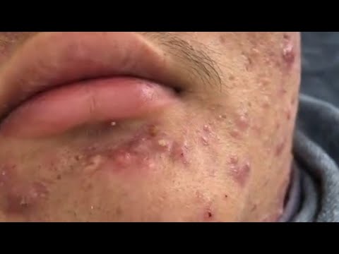 Deep Facial Cleansing for Acne | Blackhead and Whitehead Removal#asmr