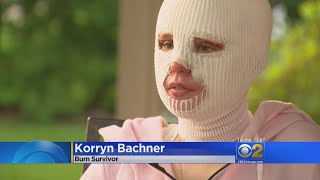 Glenbard Bonfire Burn Victim On Her Way To Recovery