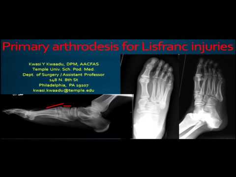 Artroza deformantă a articulațiilor genunchiului și șoldului