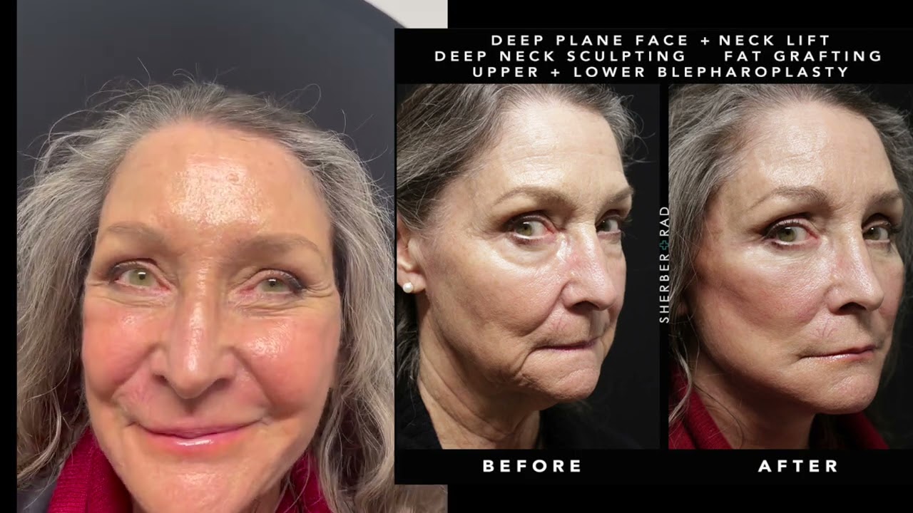 Total Face Refresh with Deep Plane Face Lift by Dr. Rad