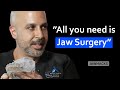 Jaw Surgery Vs MARPE The Ultimate Solution For Airway