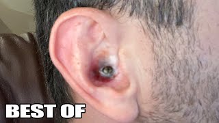 Top 10 Ear Pops!  Ear Blackheads, Pimples, Zits and Acne Popping!  Popaholics