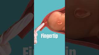 Membrane Sweep Procedure #pregnancy