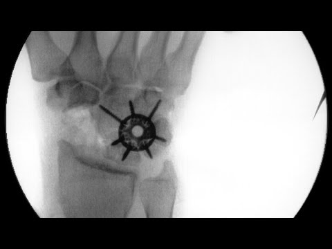 Scaphoid fracture, SNAC and SLAC wrist