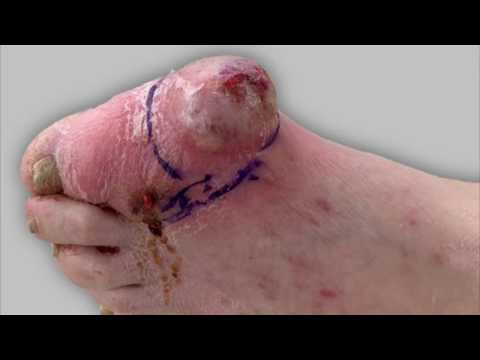 Draining pus from a foot infection