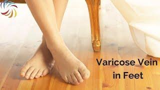Varicose Vein in Feet