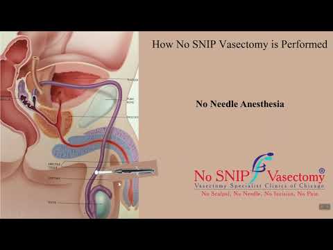 Vasectomy; The No SNIP Technique