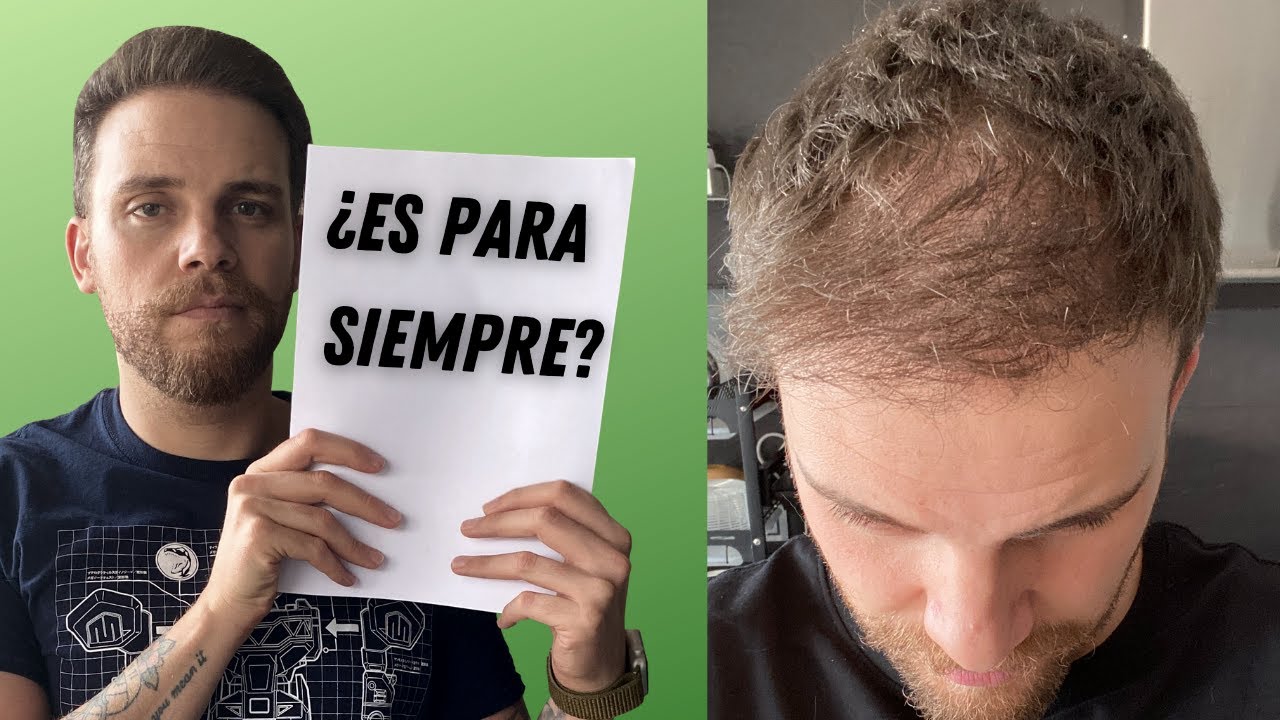 ¿SE CAE EL PELO TRASPLANTADO ¿CUÁNTO PUEDE DURAR// DR. XAVIER ÁLVAREZ