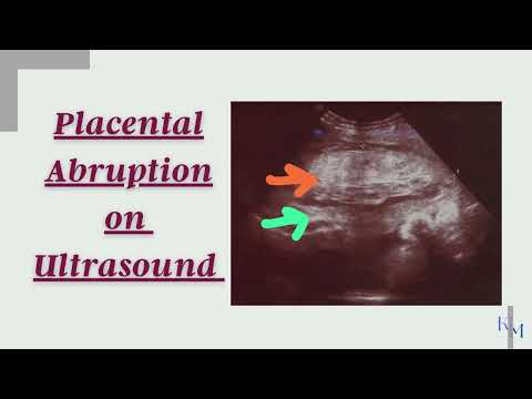 Placental Abruption Management || Placental Abruption Treatment