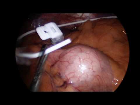 Gastric Banding - Straightforward Laparoscopic Method