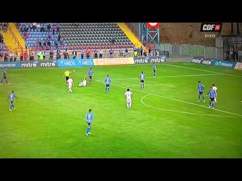 Fractura de tibia y peroné de Sebastian Ubilla