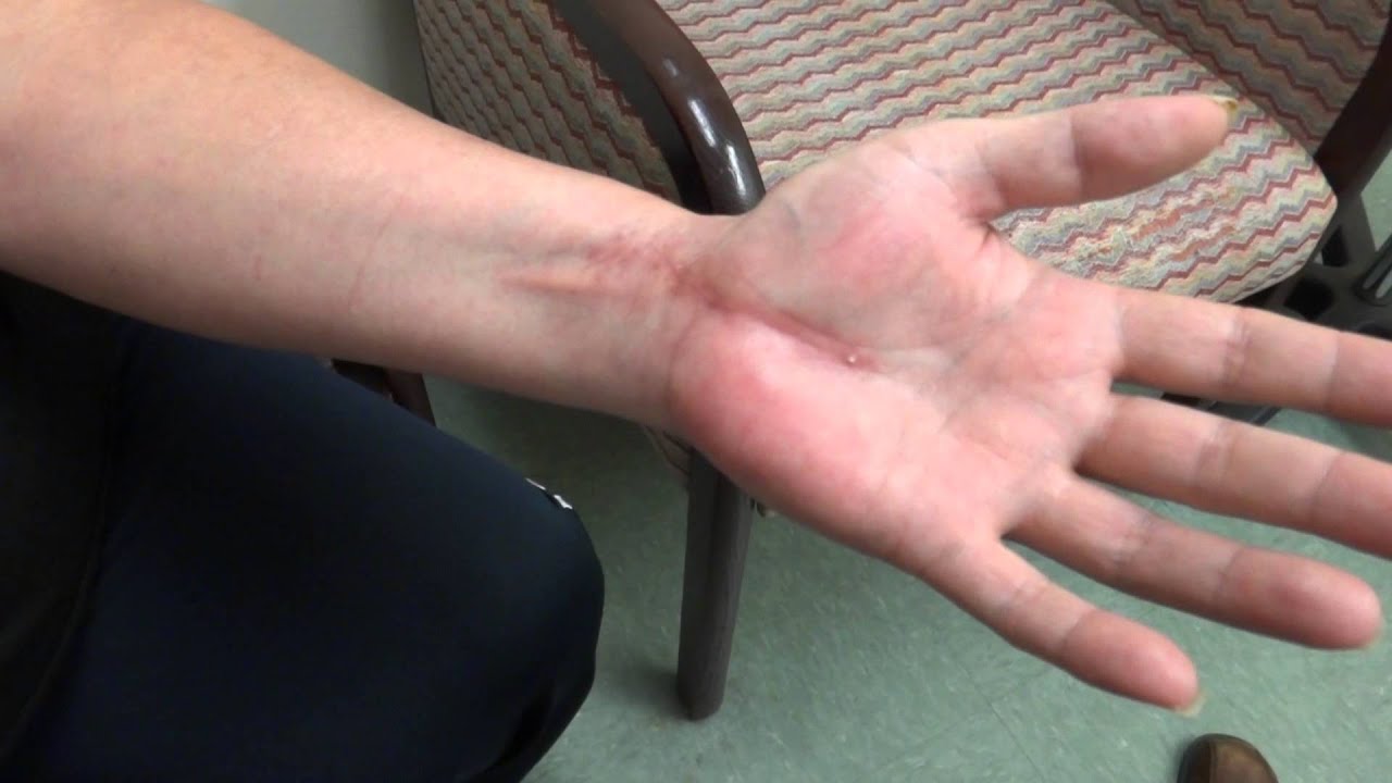 Two Months Post Carpal Tunnel Release With the Removal of the Palmar Cutaneous Nerve