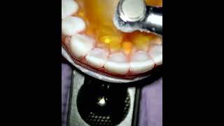 Pro Tips To Avoid Perforation When Accessing!