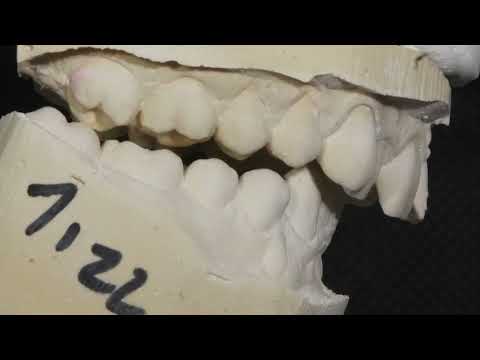 Modellanalyse - KompetenzZentrum occlusale Medizin in Eberswalde - www.zahnarzt-drmueller.de