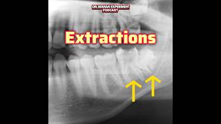 Wisdom tooth and second molar extractions
