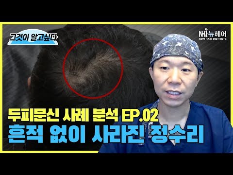 두피문신으로 정수리 없애기!! - 뉴헤어 I [두피문신][헤어라인]