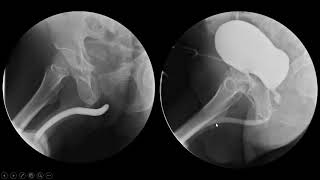 Estenose uretral pós traumática