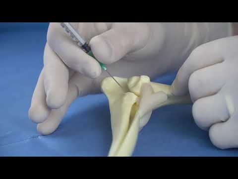 Elbow Injection Enso Discoveries