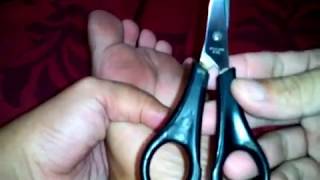 Download lagu Cara Mengobati Mata Ikan Di Telapak Kaki mp3