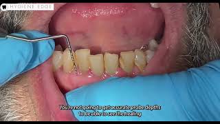 Take your probe depths AFTER periodontal therapy