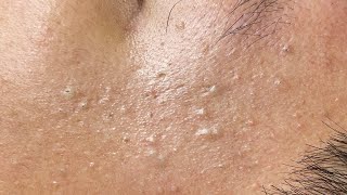 Satisfying Pimple Extraction – One by One 641 P3