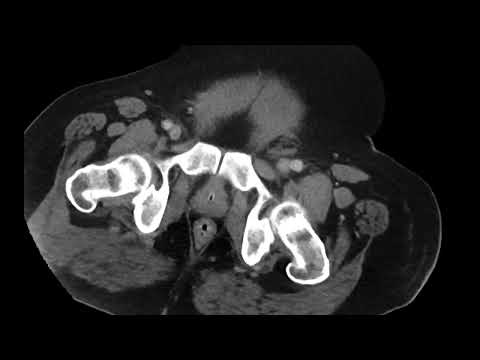 Retroperitonal hematoma with active extravasation