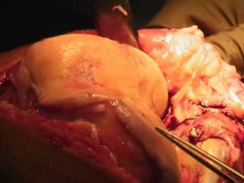 Patellofemoral Osteoarthritis des Knies Rückenschmerzen beim Vorbeugen und Gewichte zu heben