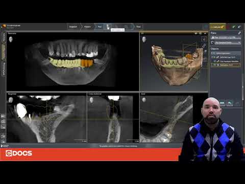 Dica do Dia: Ponte sobre Implantes