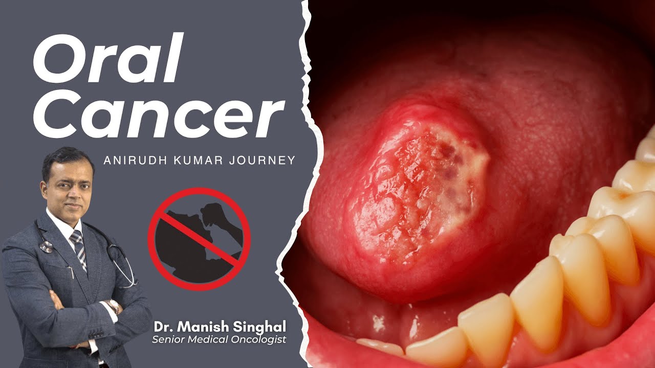 Oral cancer journey of -  Mr Anirudh  #cancer #oralcancer #cancerdoctor #doctor #bestoncologist