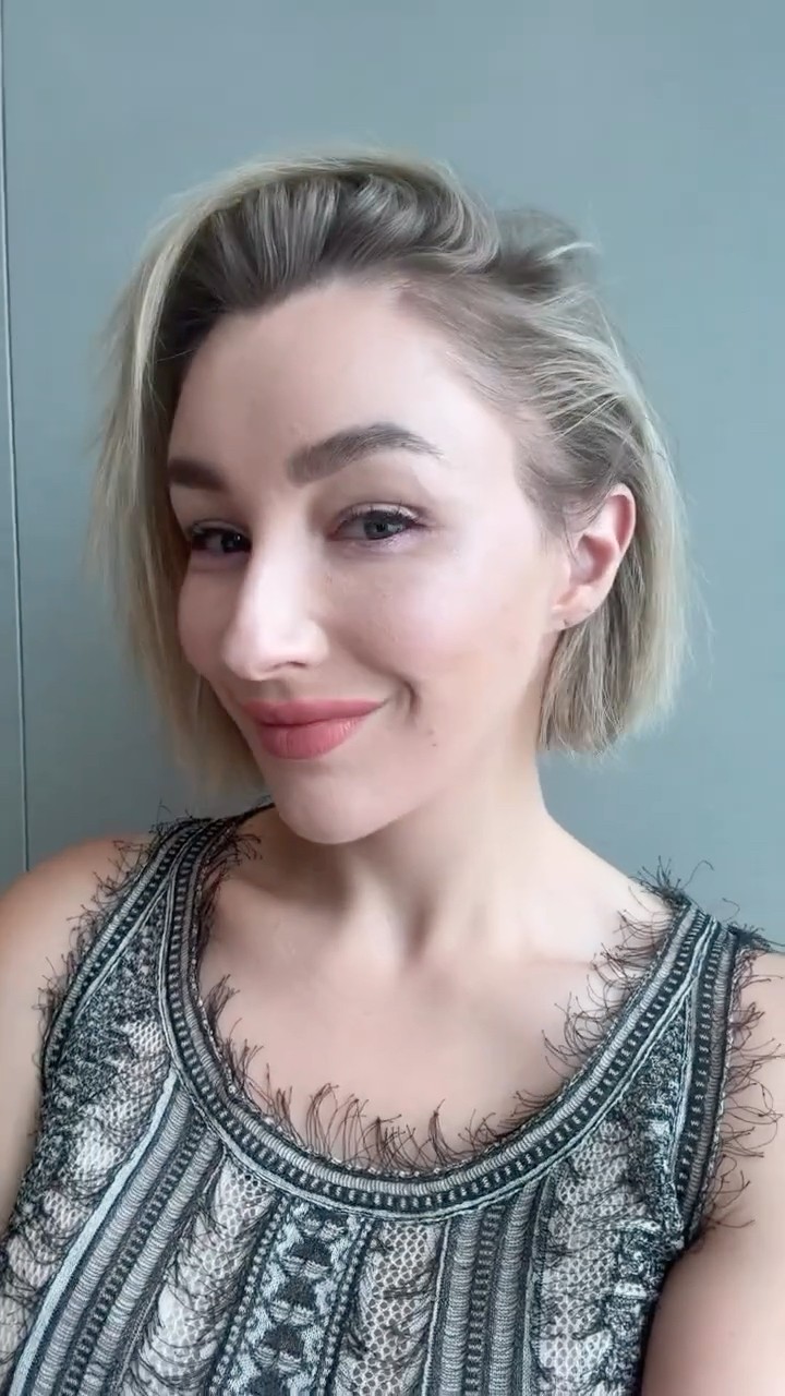 13 Days Transformation : Full Face lifting, Neck lifting, Submentoplasty, Lower blepharoplasty