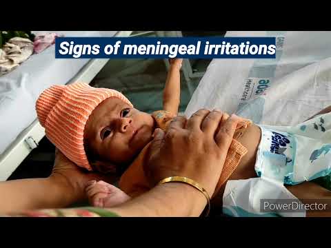 CNS Examination in children | Signs of meningeal irritation | Pediatrics