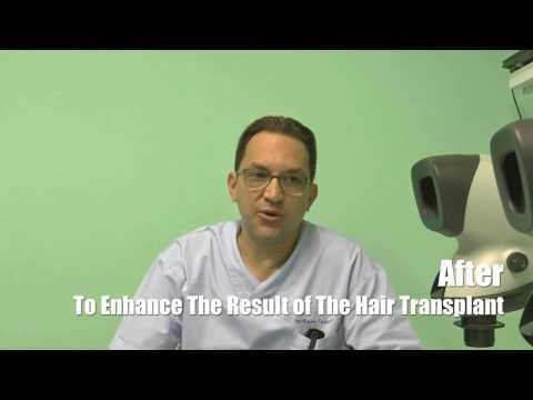 Piero Tesauro MD and SMP (tricopigmentation)