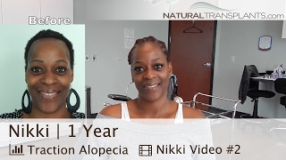 Female Hair Transplant Before and After Results | Traction Alopecia (Nikki)