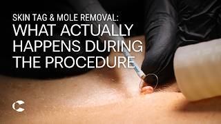 Skin Tag & Mole Removal: What Actually Happens During the Procedure