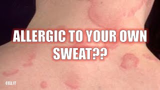 Are You Allergic To Your Own Sweat?? Here’s why….