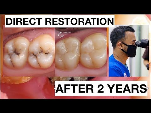 Step by step Dental Filling Composite Upper Molar Direct Restoration After 2 Years