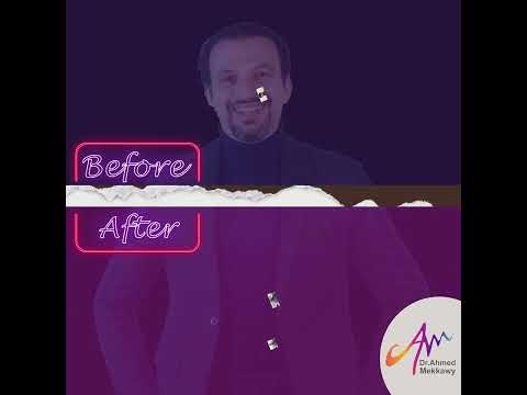 فرق كبير في الشكل والثقة بعد زراعة الشعر بدون ألم وبمظهر طبيعي