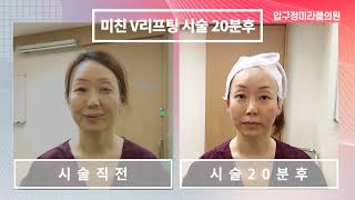 압구정미라클 미친V리프팅 리얼후기